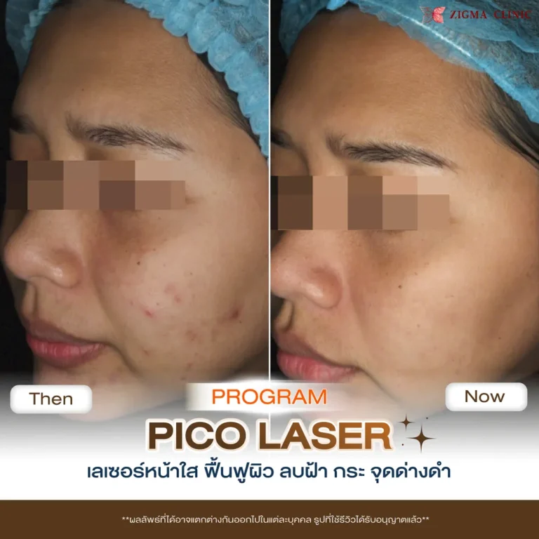 รีวิวโปรแกรมเลเซอร์หน้าใส Pico Laser 03
