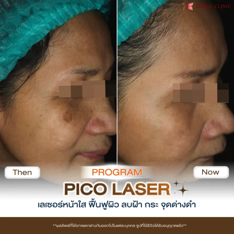 รีวิวโปรแกรมเลเซอร์หน้าใส Pico Laser 04