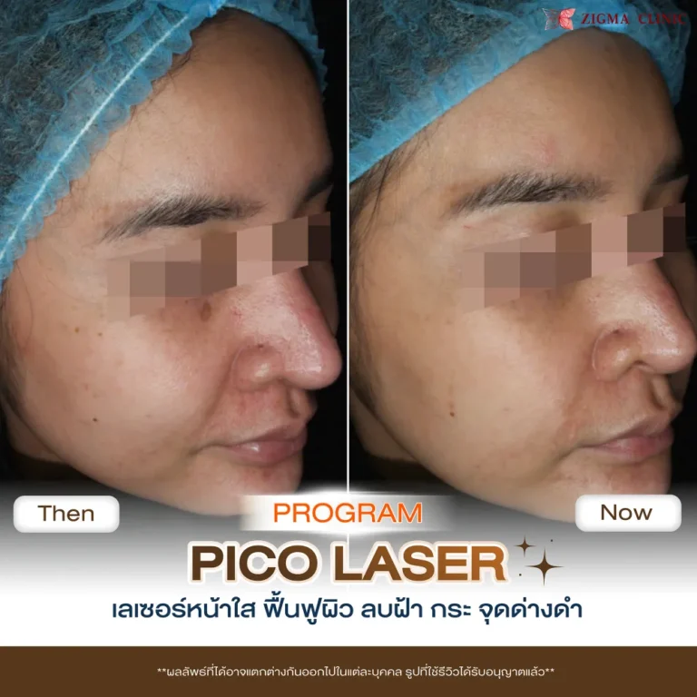 รีวิวโปรแกรมเลเซอร์หน้าใส Pico Laser 05